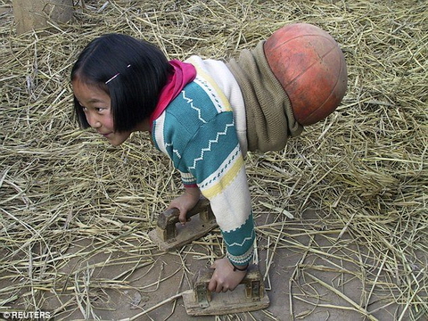 Cuộc đời tuyệt diệu của 'cô bé bóng rổ' chỉ có nửa người