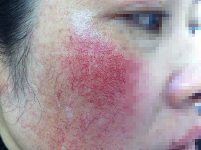 Bệnh nhân bị mỹ phẩm chứa hóa chất xâm nhập vào mô da mặt. Ảnh: 