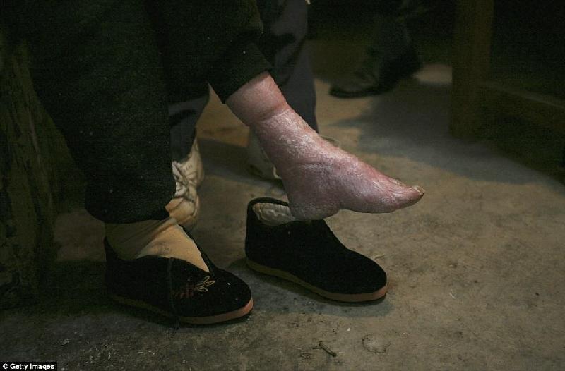 Bó chân là một hủ tục xuất hiện ở Trung Quốc từ thời nhà Tống, khi chuẩn mực cái đẹp của người phụ nữ là có đôi bàn chân nhỏ. Hủ tục này kéo dài hàng nghìn năm, trải qua nhiều triều đại phong kiến, và chỉ kết thúc ở thế kỷ 20. Ảnh: Getty Images.