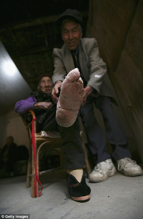 Sau rất nhiều năm bị quấn chặt trong băng vải và đi đôi giày bé xíu, các ngón chân của bà Luo Pu dính lại, méo mó. Da chân cũng bị khô, nứt nẻ, và bong tróc. Ảnh: Getty Images.