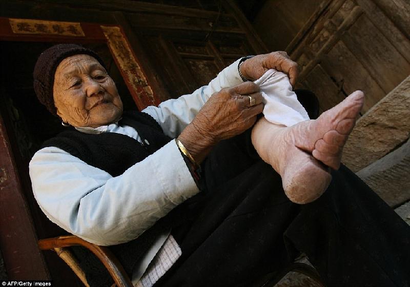 Bàn chân với vết cắt sâu và phần ngón bị gập hẳn xuống của cụ Zhou Guizhen, 86 tuổi, khiến người xem rùng mình sợ hãi vì những cơn đau mà cụ đã chịu đựng. Ảnh: AFP/Getty Images.
