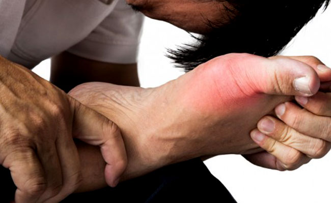 Gout thường gây ra cơn đau ở các khớp