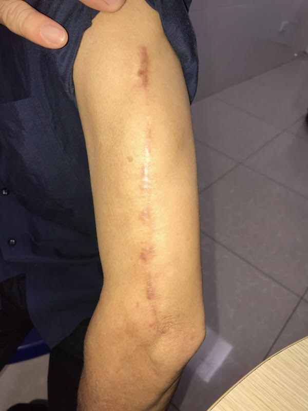 Sau khi phẫu thuật, phần cánh tay chỉ bị một vết sẹo chạy dài.